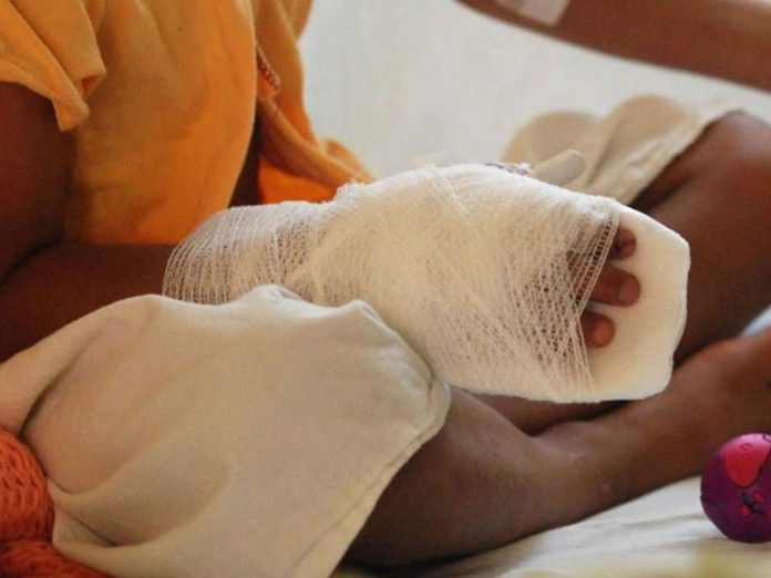 Ninos-quemados-por-polvora